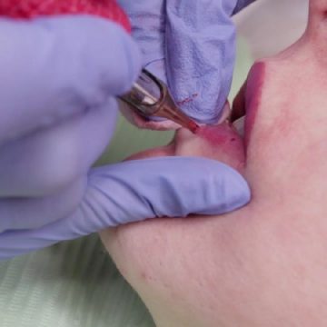 Урок 4 — Врожденный дефект губ, асимметрия и рубцы