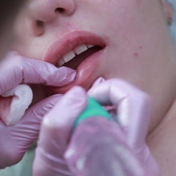 Урок 2 — Исправление приобретенного дефекта губ, рубец после удаления гемангиомы